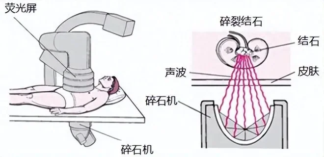 SWL双重含义：体外冲击波碎石术与短波收听者解析